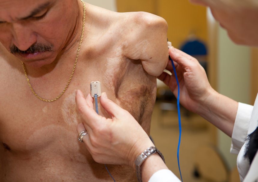 Arm Dynamics patient testing electrode placement for myoelectric prosthesis