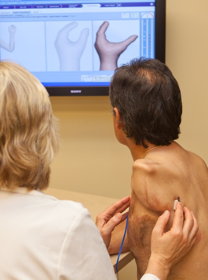 Arm Dynamics patient and clinician testing myoelectric pickup sites