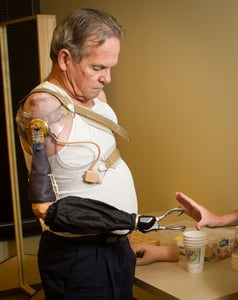 Arm Dynamics patient wearing a Dynamic Arm Elbow