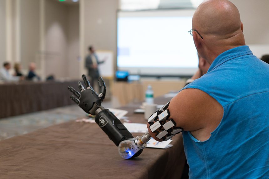 Osseointegration amputee participating in Arm Dynamics' upper limb prosthetic symposium