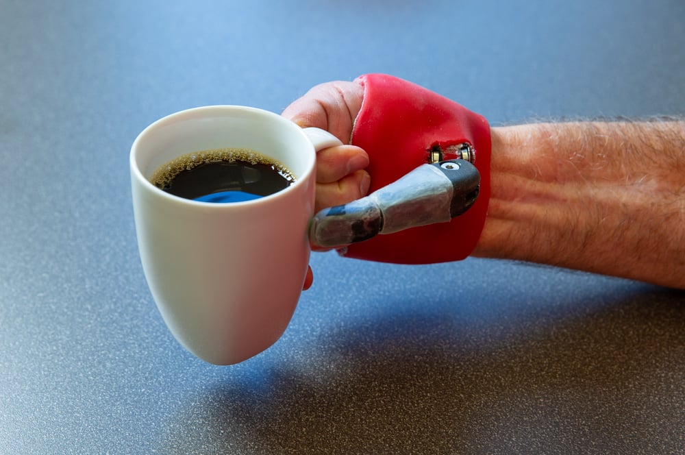 Dennis Roberts Passive Positional Thumb Prosthesis