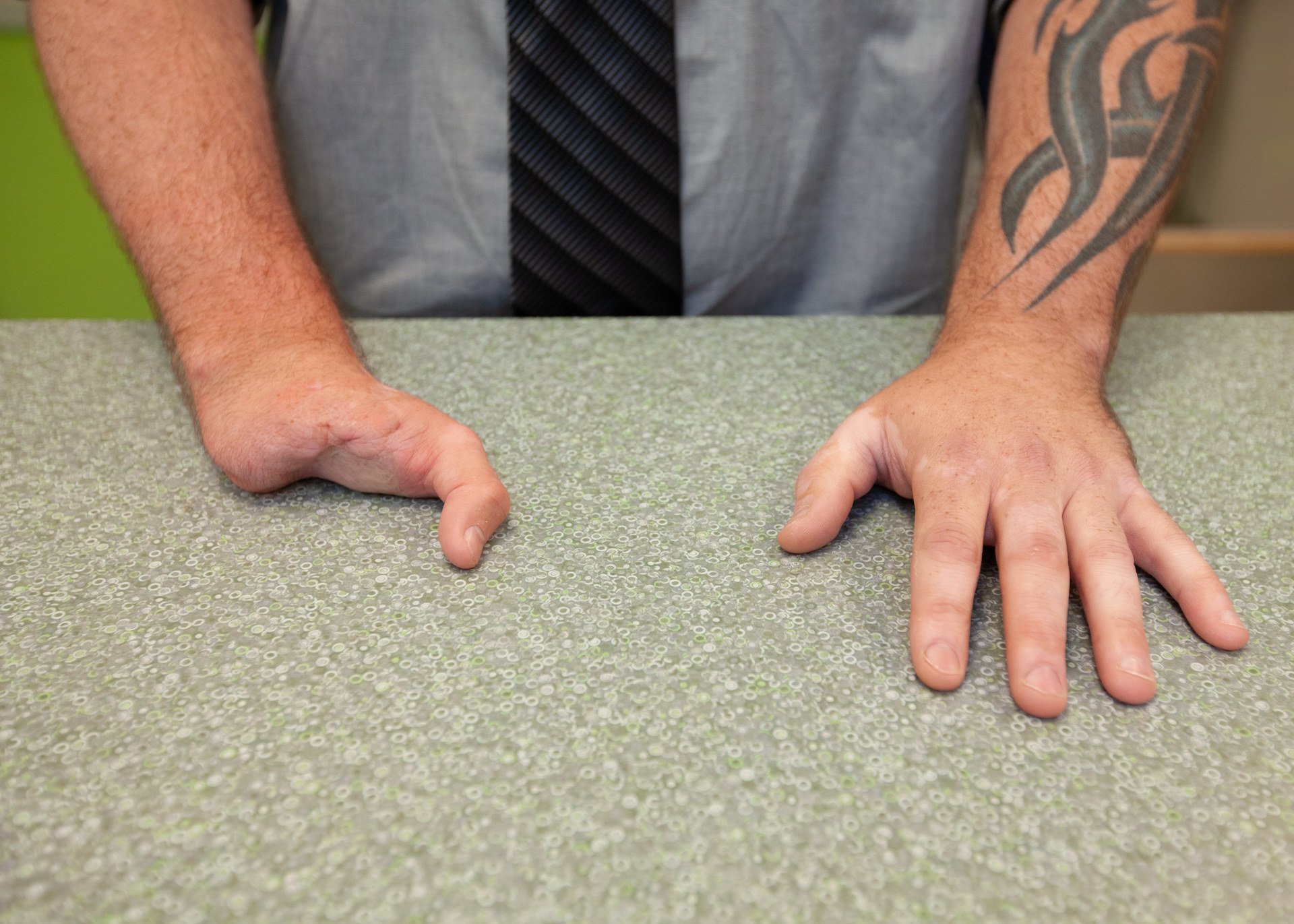 A partial hand patient without his prosthesis