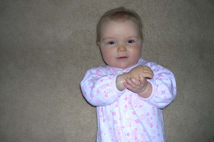 Leg prosthesis for toddlers picture