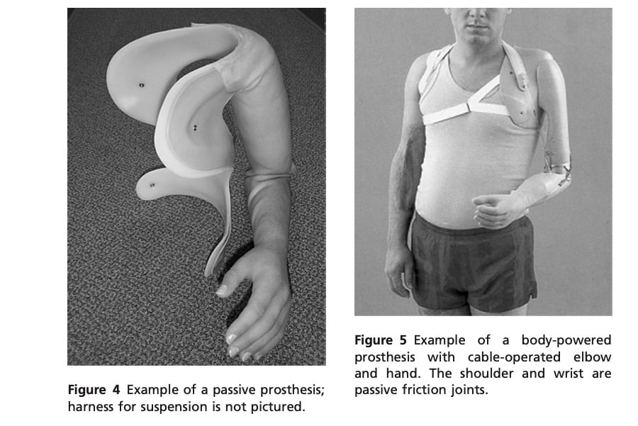 Amputations About the Shoulder:
Prosthetic Management