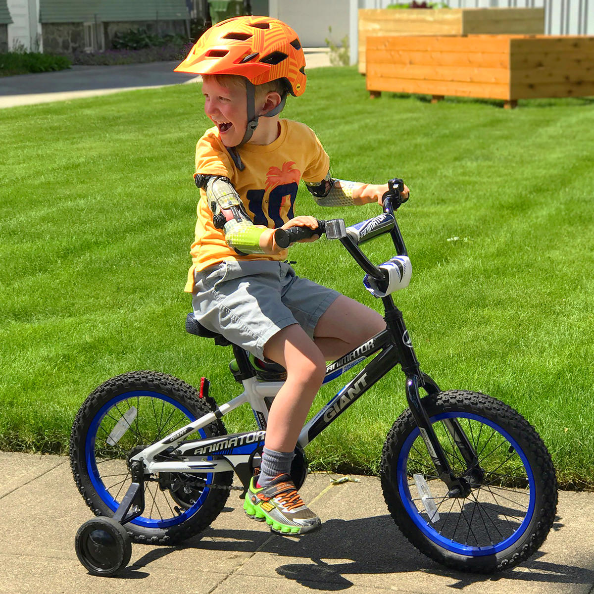 Congenital bilateral pediatric patient Jameson Davis rides his bicycle with his myoelectric prostheses