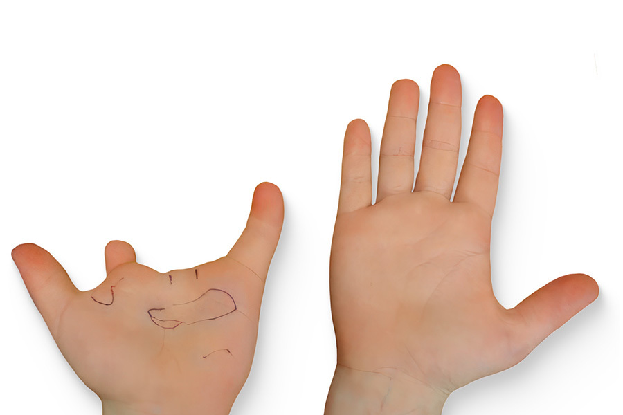 Congenital-Hand-Listing