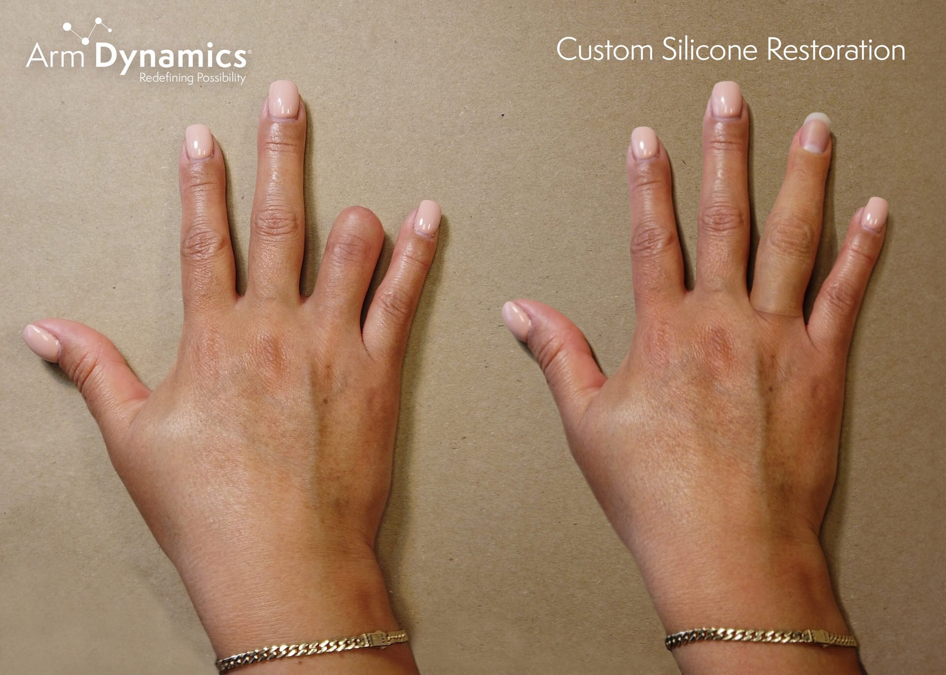 Custom Silicone Restoration for a partial hand patient. Before and after.