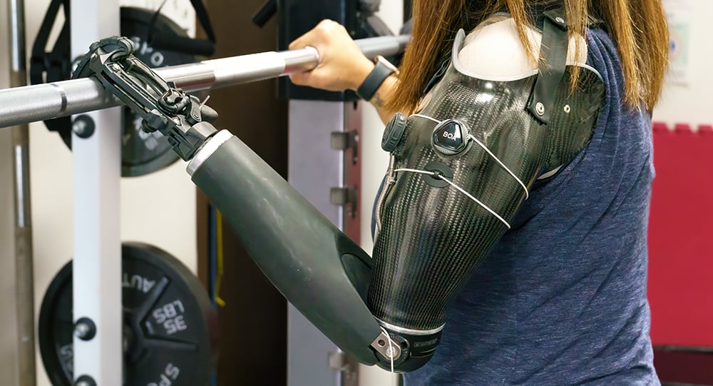 Claudia's hybrid prosthesis