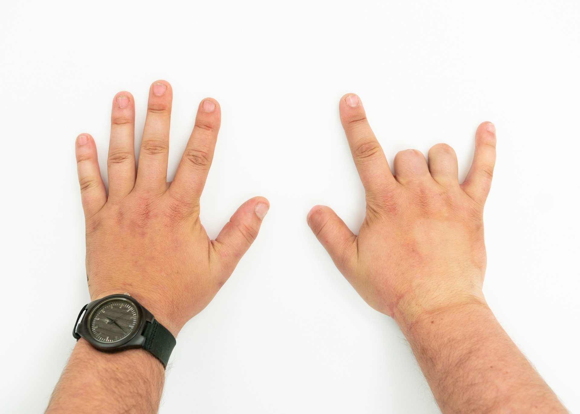 A partial hand patient without prosthesis