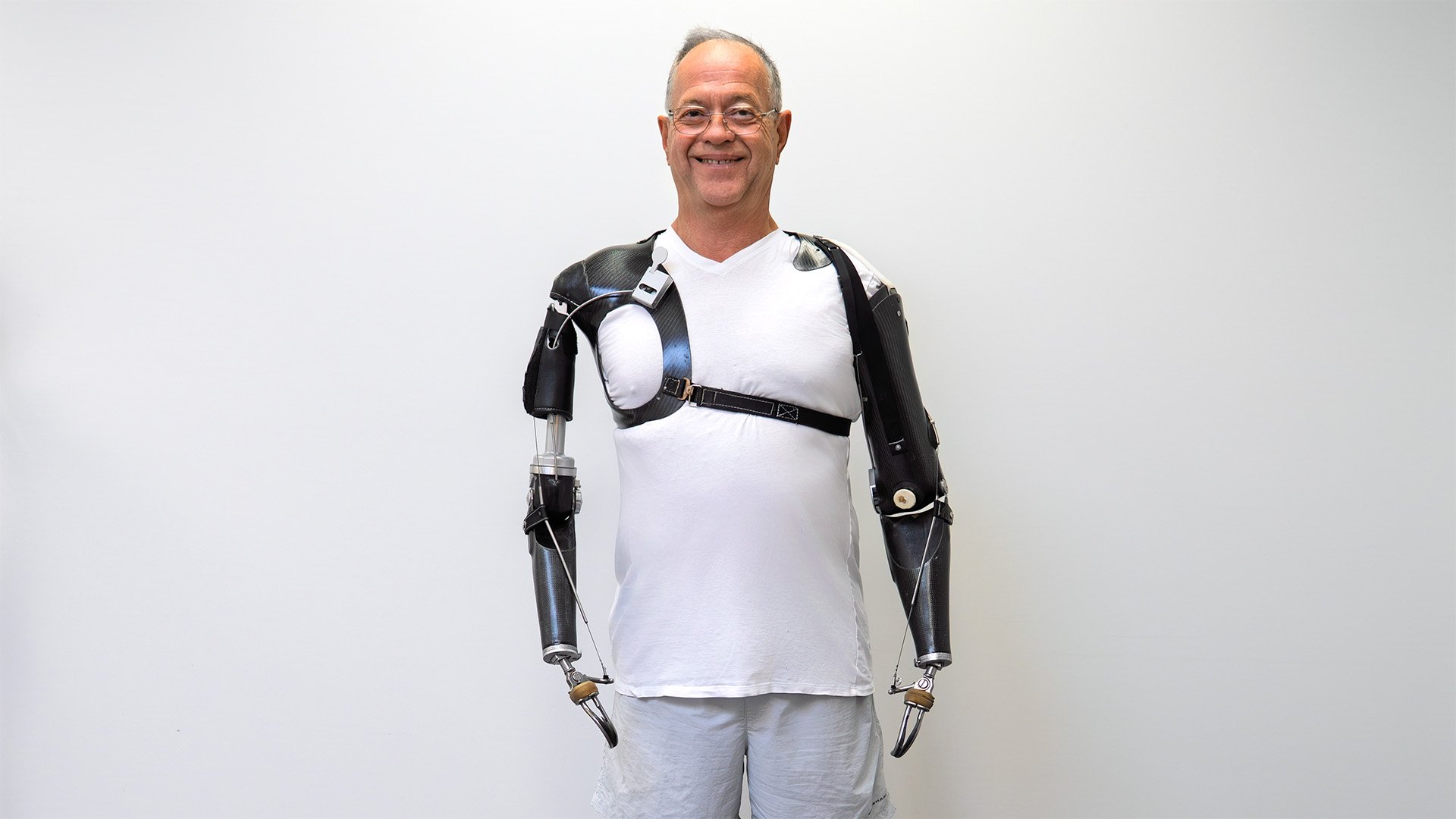 Dougs Prosthesis - Bilateral Shoulder and Transhumeral