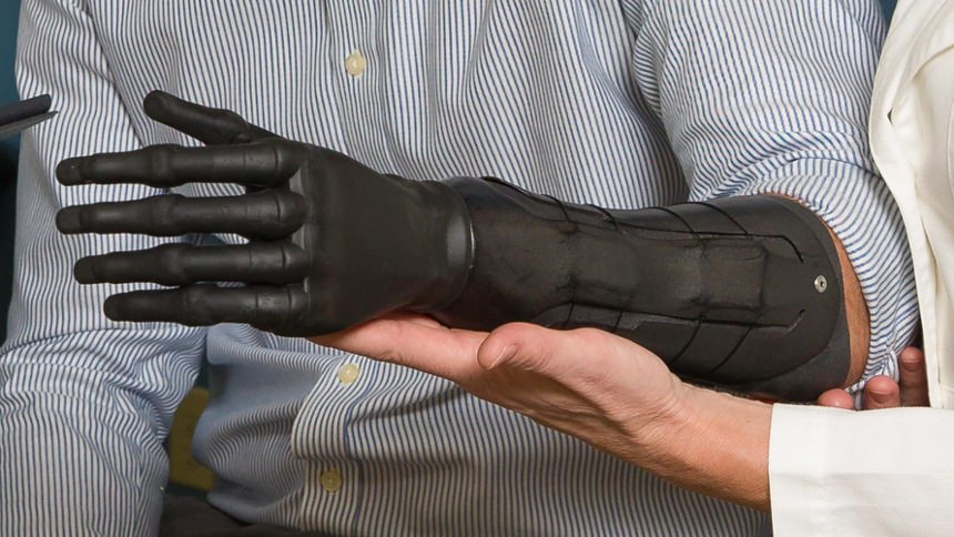 Custom BOA socket with iLimb Quantum Hand
