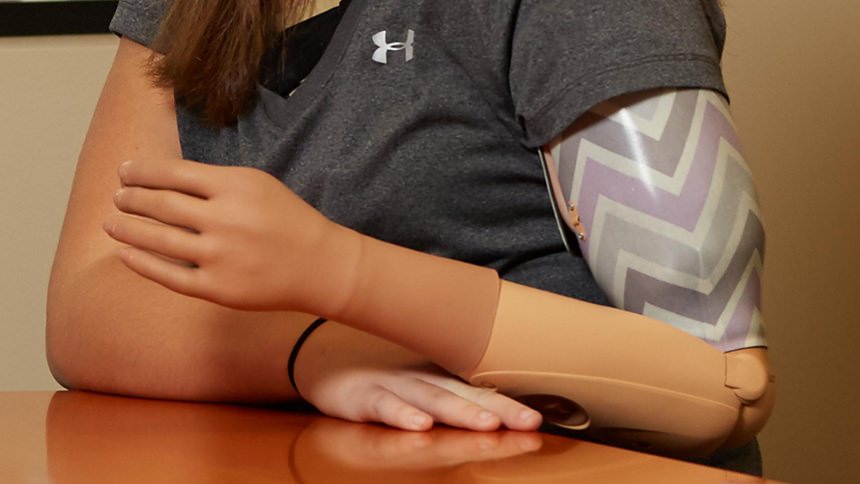 Custom Socket with Utah Elbow and Sensorhand