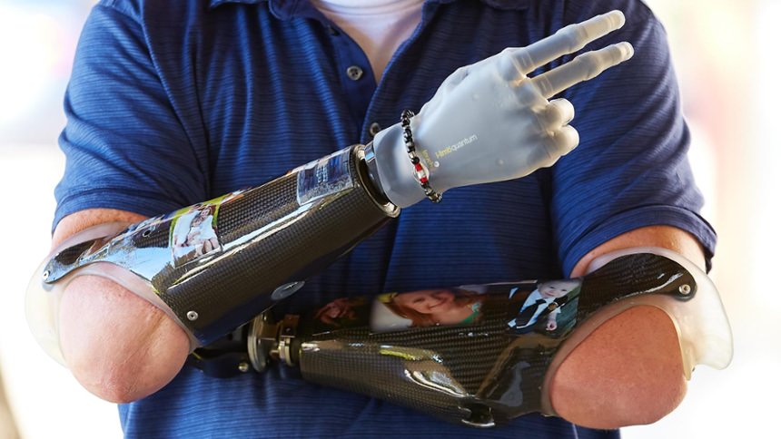 Carbon Fiber Socket Frame with i-limb Hand