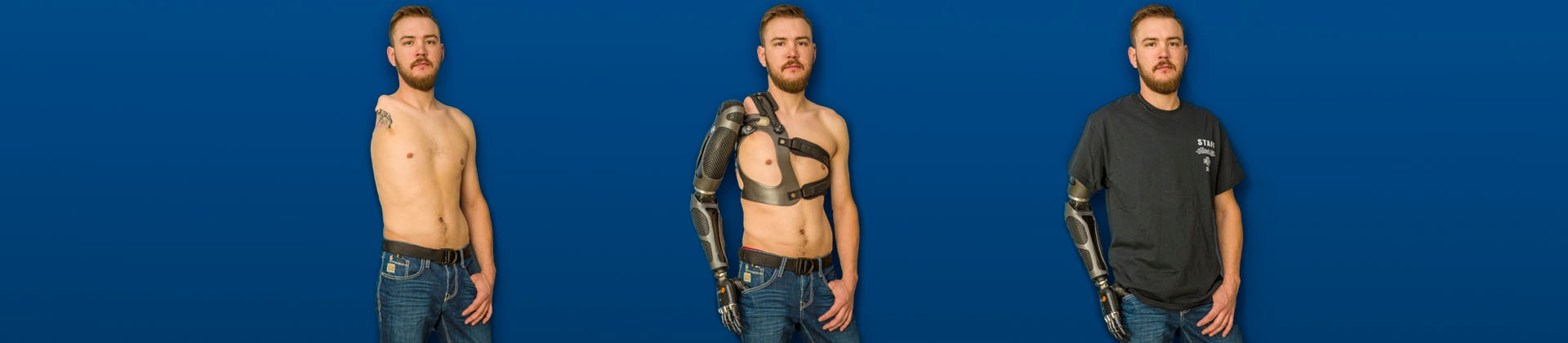 Sam Rosecrans before and after prosthesis