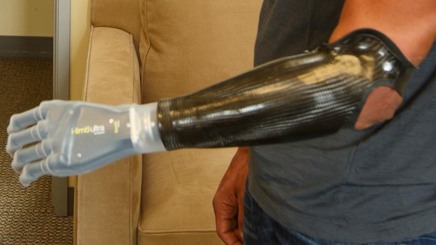 Custom Carbon Fiber Socket with i-limb hand