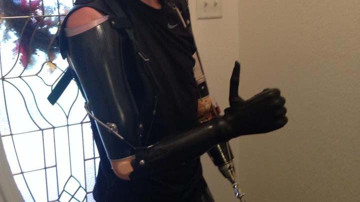 Custom above the elbow socket with i-limb hand