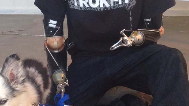Custom above the elbow socket with body-powered hooks