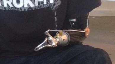 Custom above the elbow socket with body-powered hooks