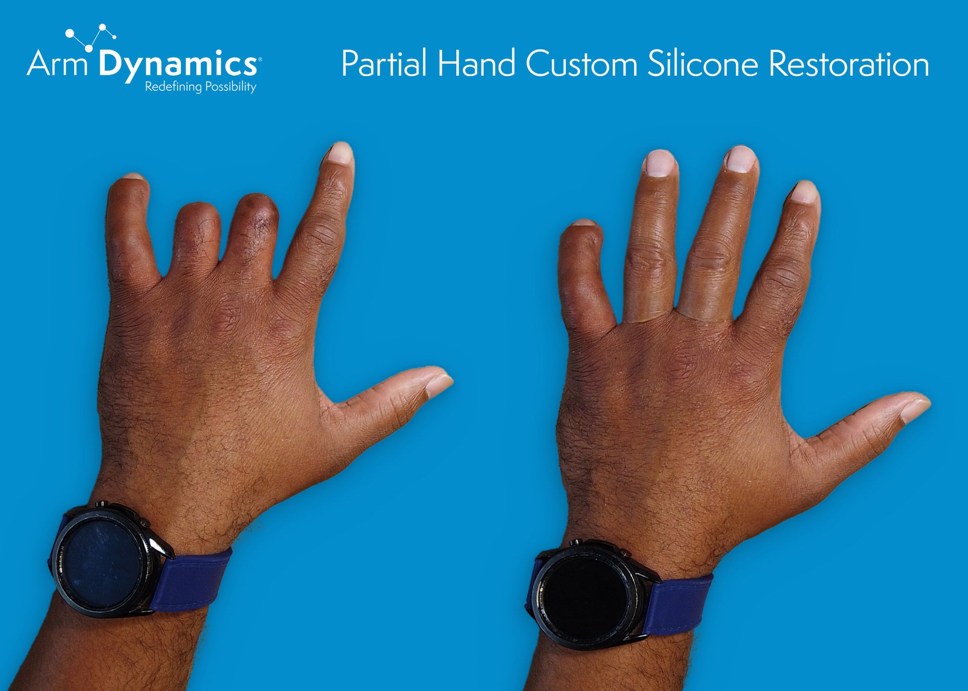 Partial hand custom silicone passive restoration. Before and after.