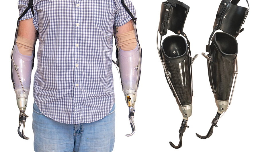 Initial prostheses on the left with definitive prostheses on the right