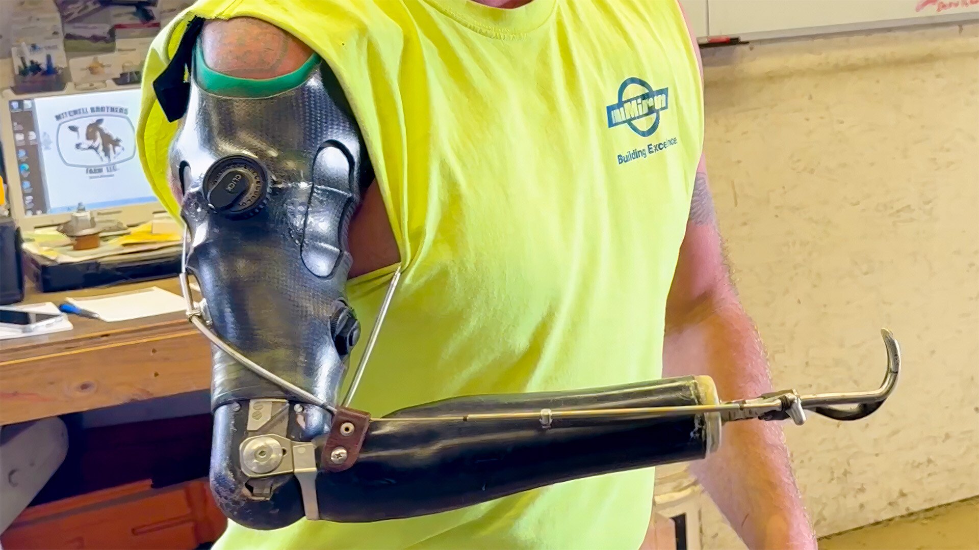John Mitchell Prosthesis