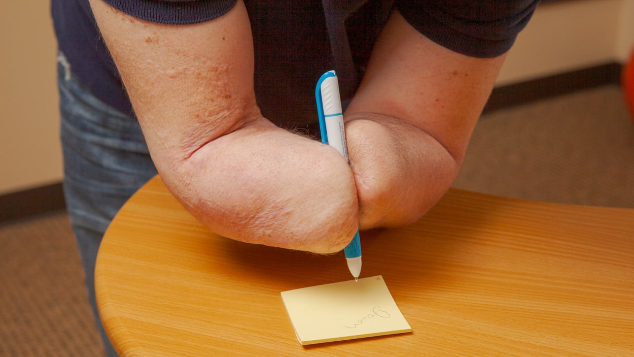 No Prosthesis Image 2
