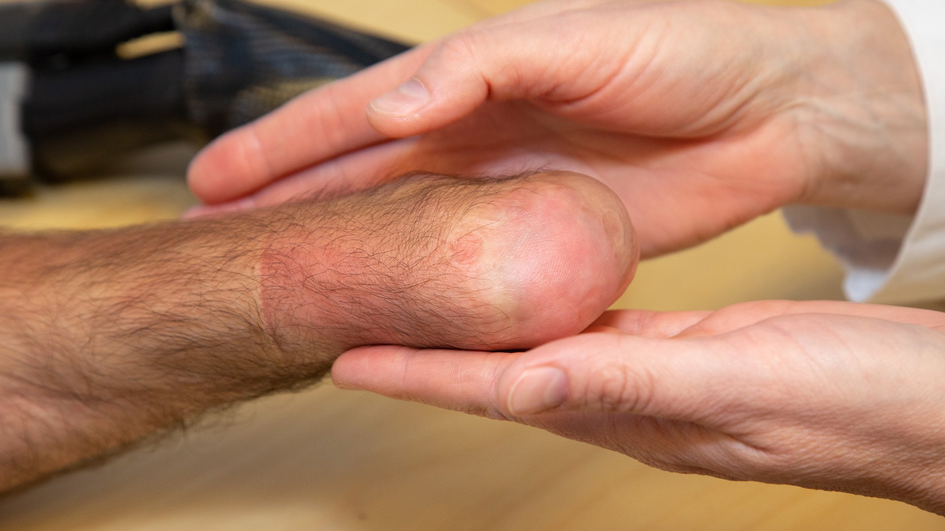 Finger and Partial Hand Prosthetic Options | Arm Dynamics