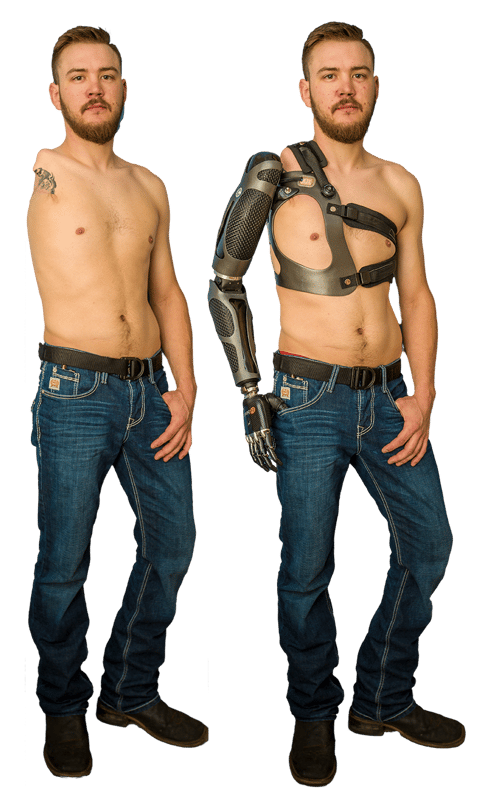 Sam Rosecrans with and without prosthesis