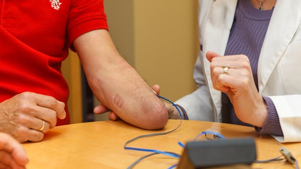 Transradial (Below the Elbow) Amputee