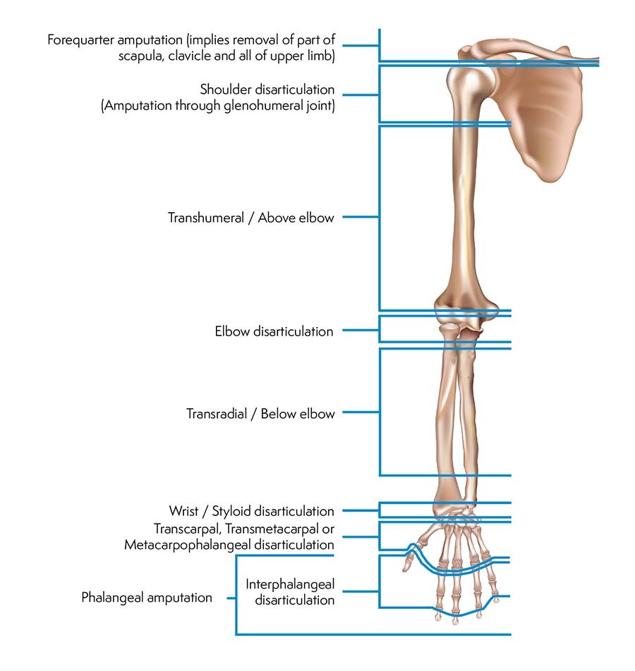 Levels of Amputation