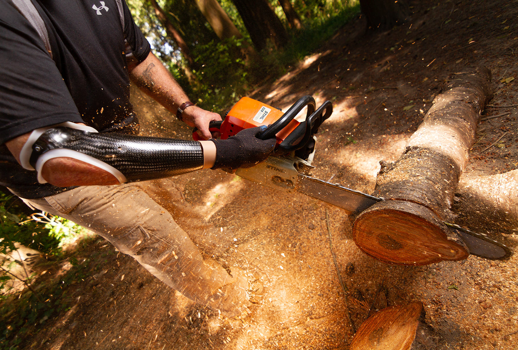 Using a chainsaw with a rugged custom transradial socket and myoelectric hand