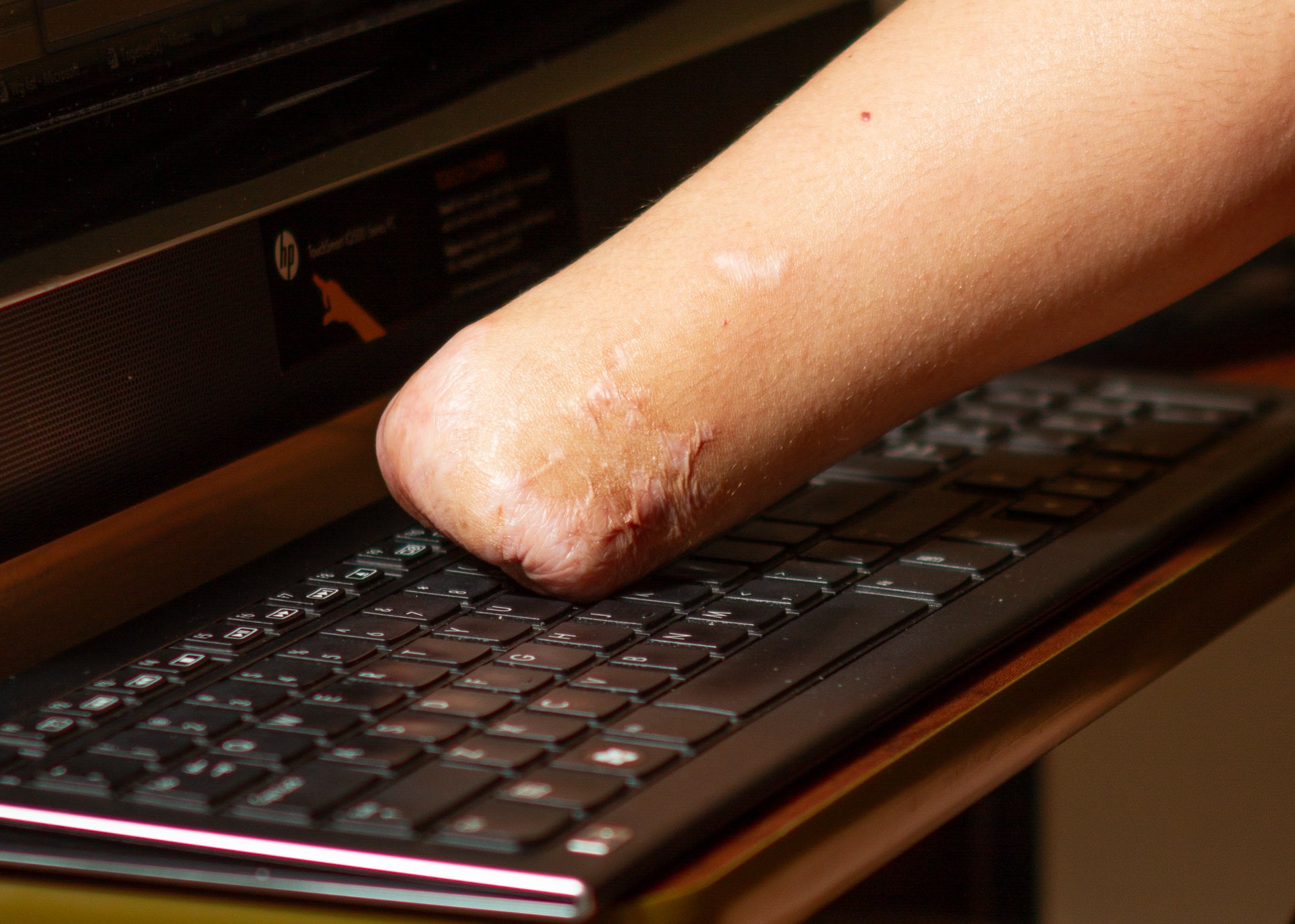 A patient with a below the elbow amputation finds it difficult to type without a prosthesis