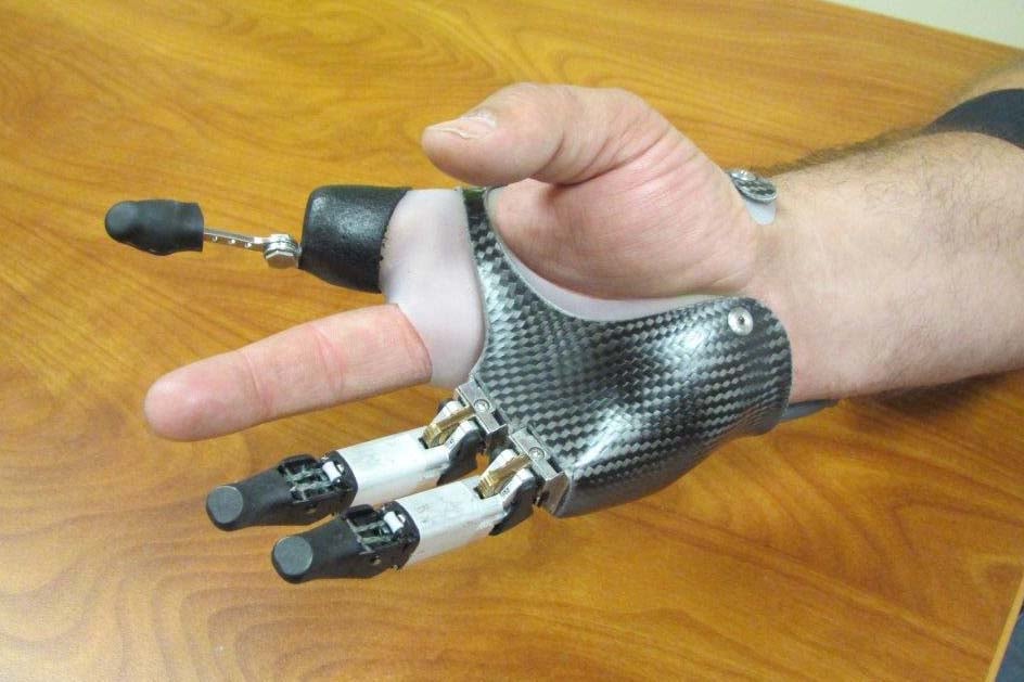 Hybrid partial hand prosthesis photo