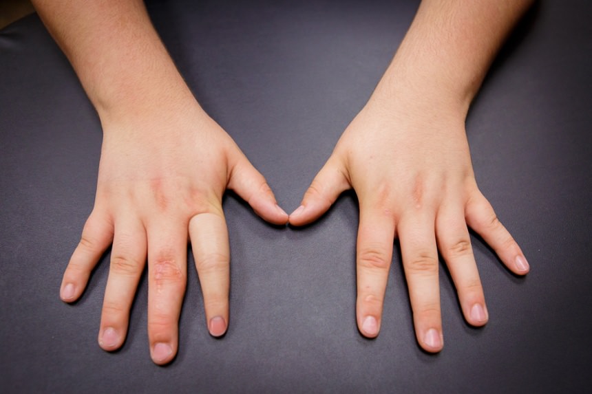 Passive Partial Hand Prosthesis photo