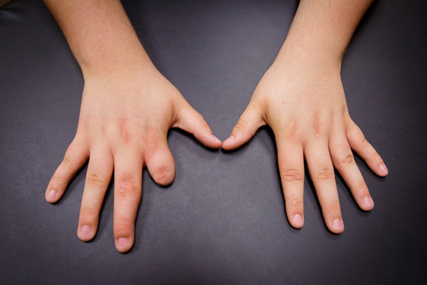 No Prosthesis photo