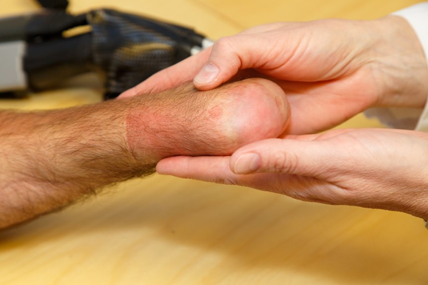 No Prosthesis photo