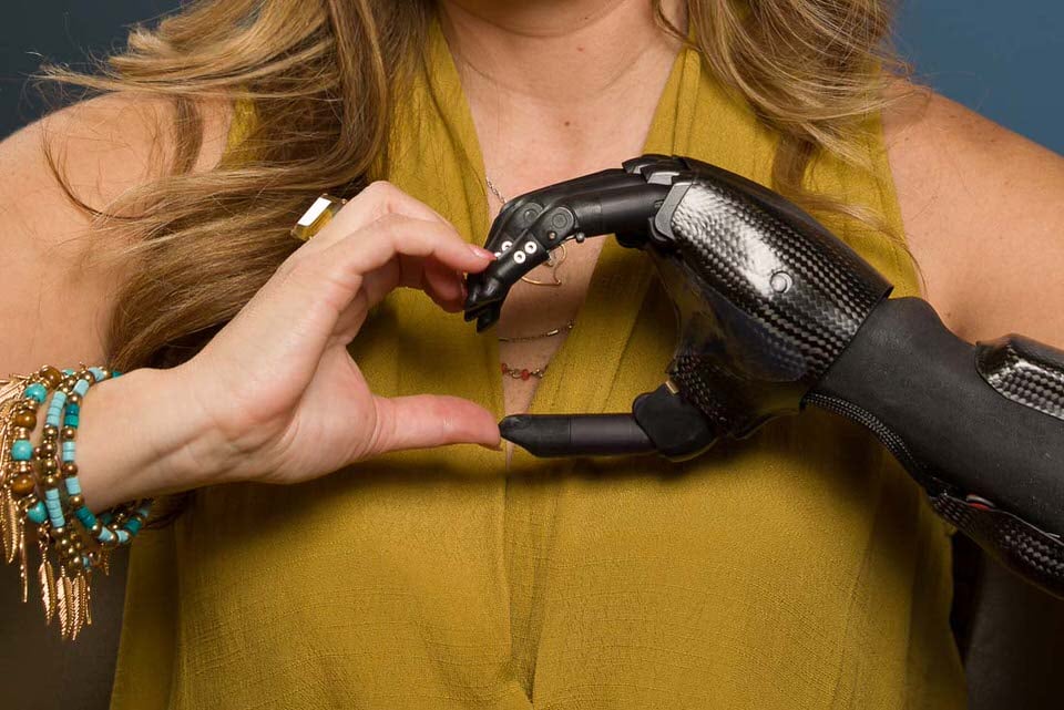 Electrically powered partial hand prosthesis photo