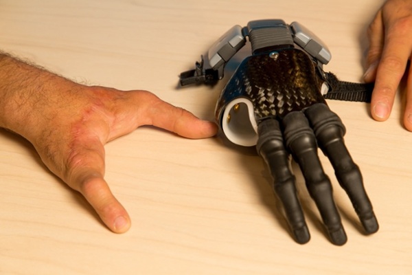 Arm Dynamics patient with myoelectric finger prosthesis