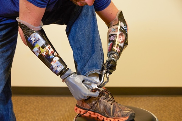 Arm Dynamics patient tying his shoe with a myoelectric hand prosthesis