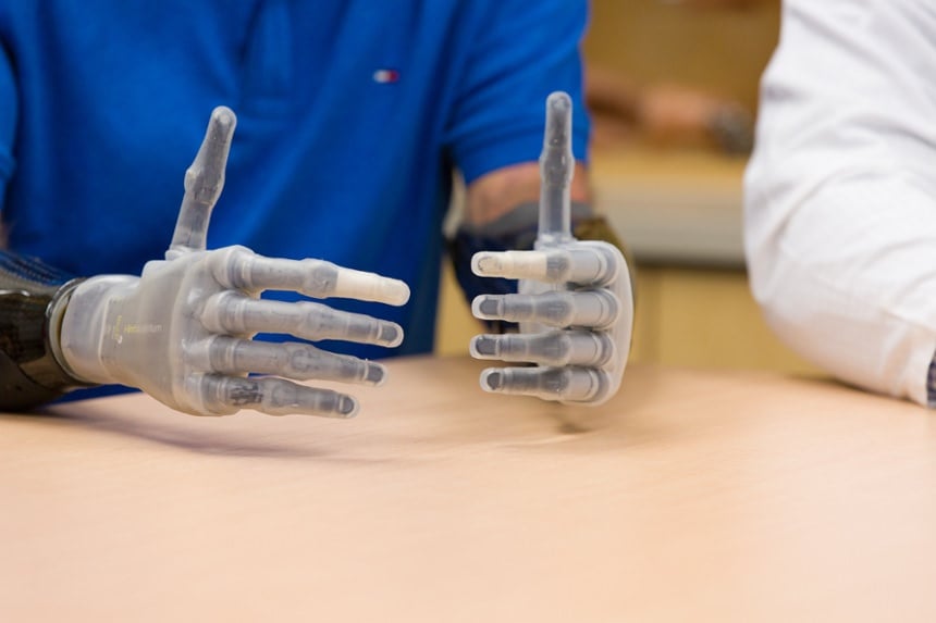 Arm Dynamics bilateral amputee with two myoelectric hand prostheses