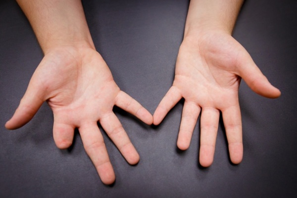 Arm Dynamics patient before silicone restoration of index finger