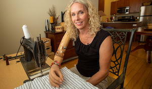 Lifelong Prosthesis Users