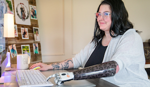 Adults with Congenital Limb Differences
