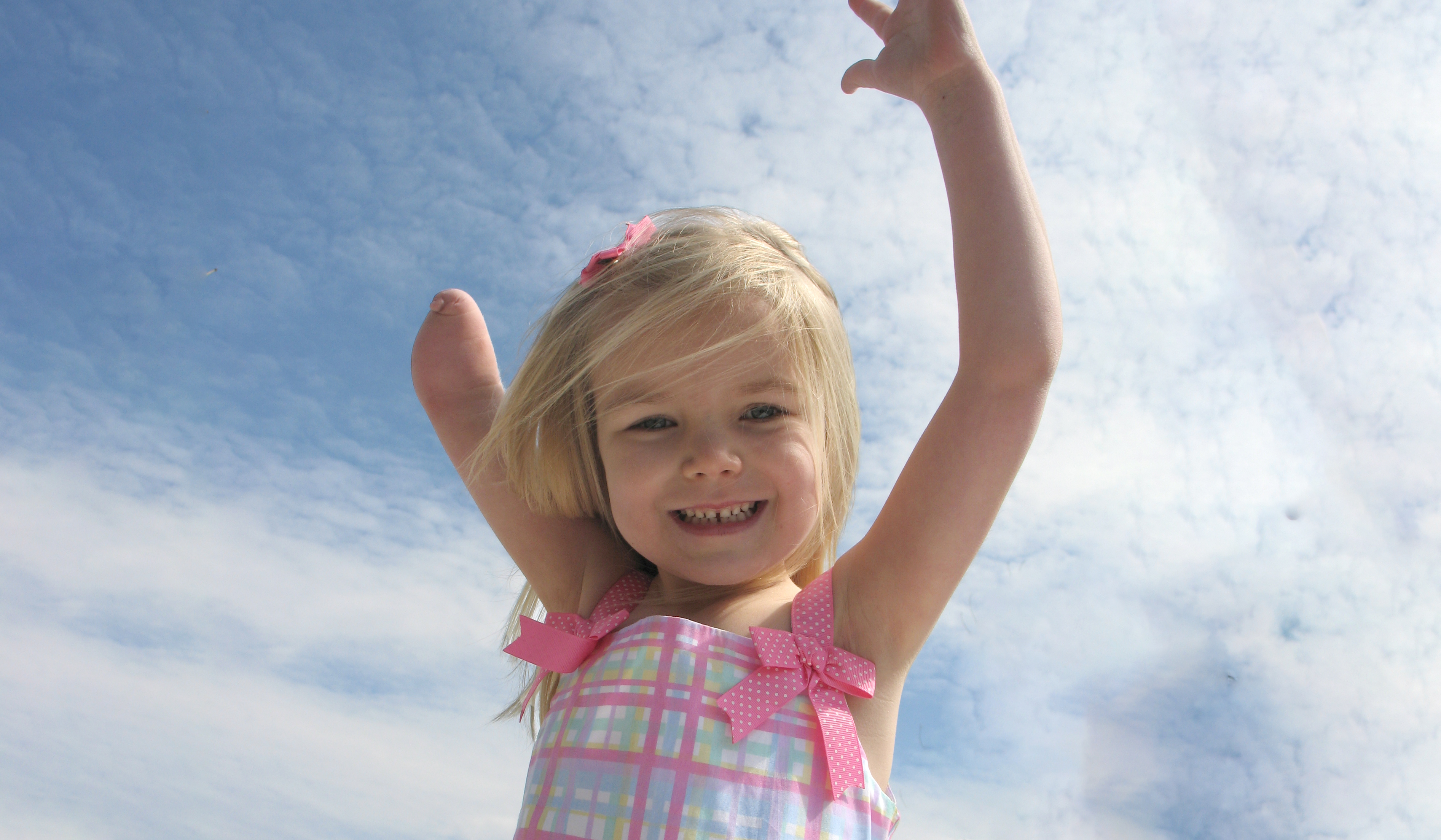 Congenital Limb Differences: What to Know Before Your Child is Born