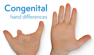 Prosthetic Options for Congenital Hand Differences in Children