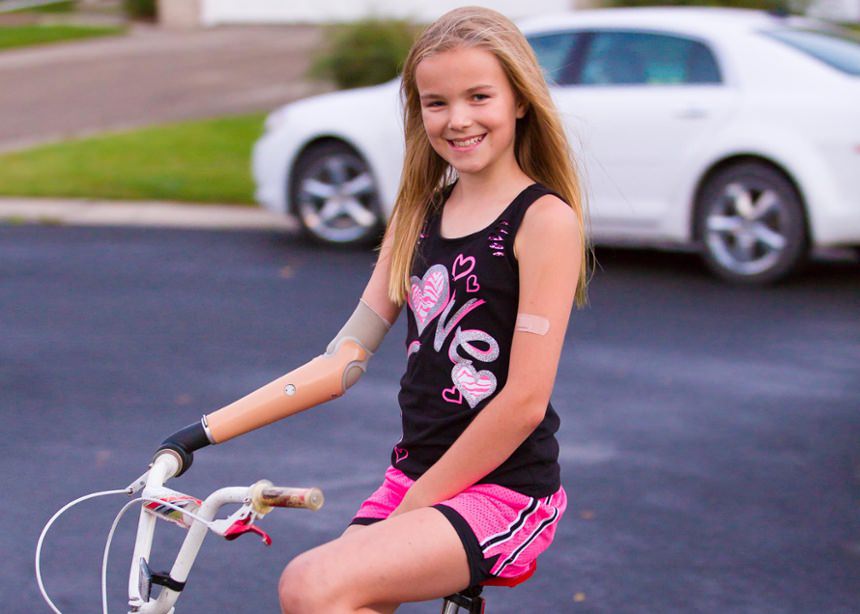 Amber Peterson Pediatric Child Prosthesis Activity Specific Bicycle Riding