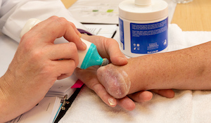Introduction to Phantom Limb Pain and Phantom Sensations