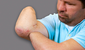 Introduction to Neuromas in Amputated Upper Limbs