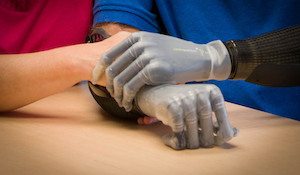 Effects of An Amputation on a Partnership: Partner Perspective