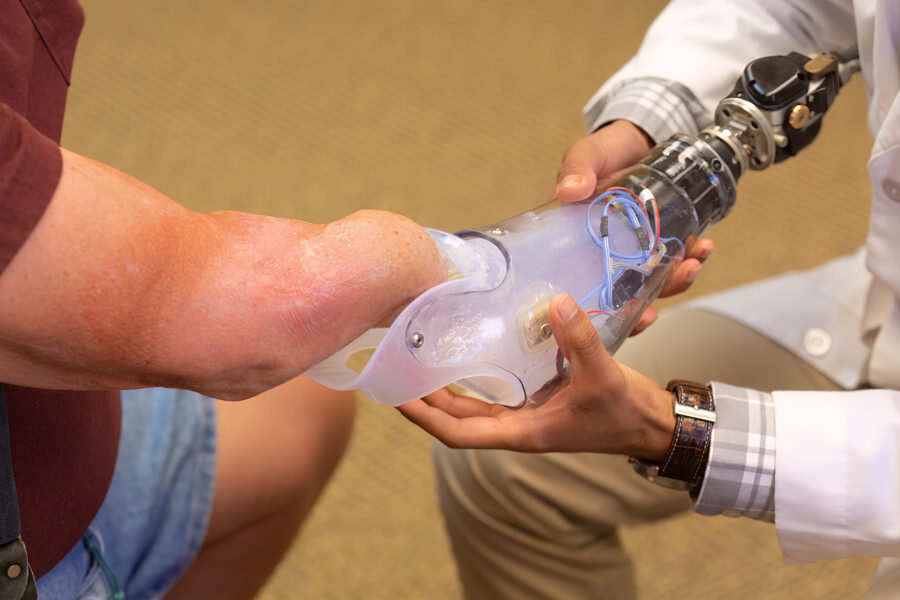 How Long Does It Take to Get Fitted for an Upper Limb Prosthesis?